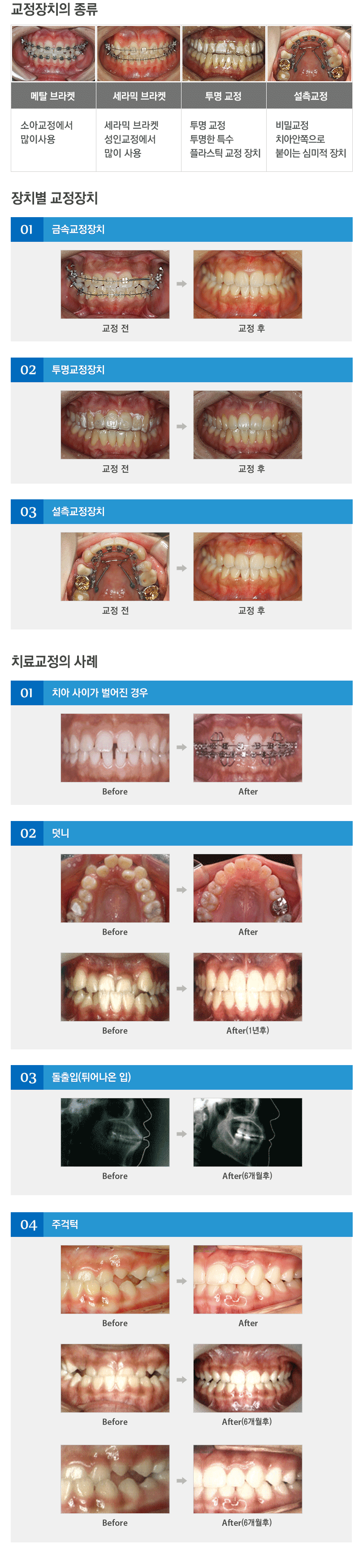 교정장치의 종류 1.메탈브라켓: 소아교정에서 많이 사용합니다. 2.세라믹 브라켓:성인교정에서 많이 사용합니다. 3.투명교정:투명한 특수 플라스틱 교정 장치를 사용합니다. 4.설측교정:비밀교정으로 치아안쪽으로 붙이는 심미적 장치입니다